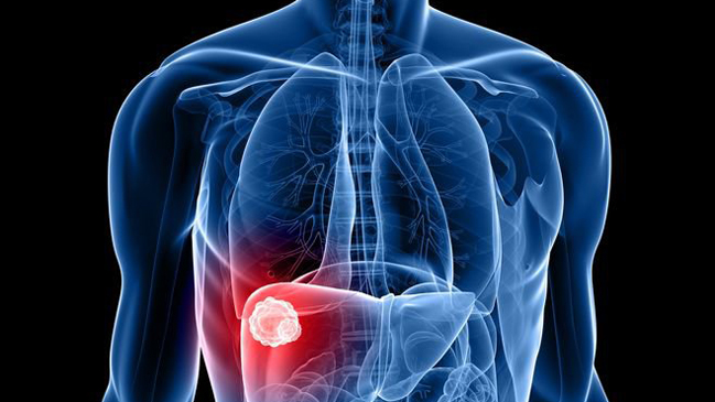 Descubren una mutación genética que causa cáncer de hígado