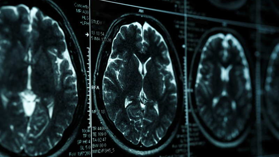 Expertos chinos informan del primer caso de un paciente de 19 años con Alzhéimer