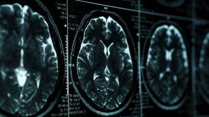  Expertos informan del primer caso de un paciente de 19 años con Alzhéimer  