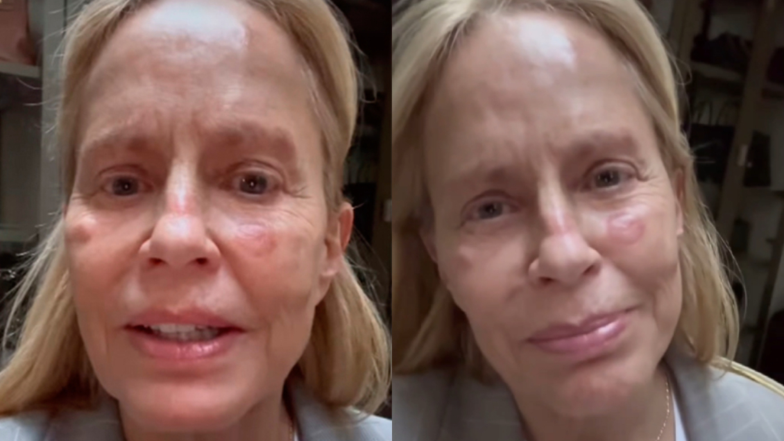 Cecilia Bolocco se baja de la Teletón por lesiones en su piel