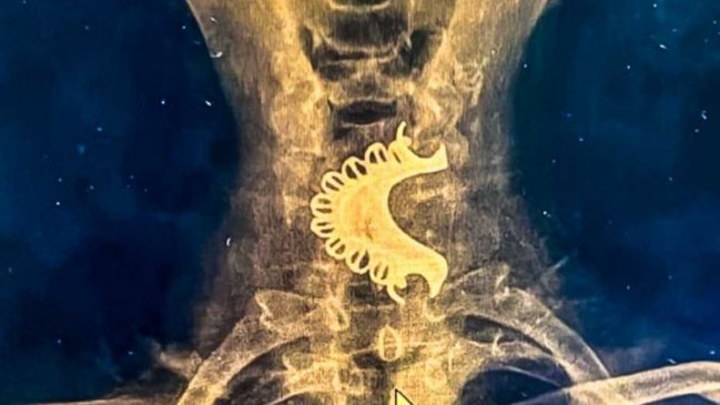 Adulto mayor se tragó su dentadura postiza y pasó cuatro días con ella en la garganta