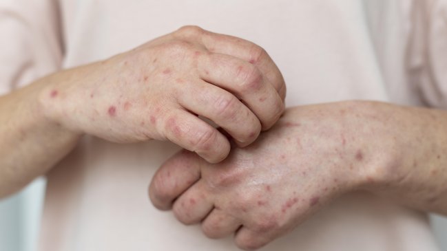 Por brote en Maule: Recomendaciones para prevenir la escarlatina