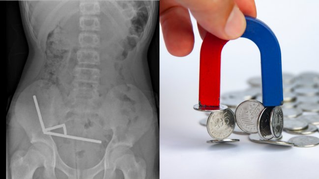 Radiografía y foto referencial de imán