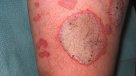 Día Mundial de la Psoriasis: Los mitos más comunes de la enfermedad