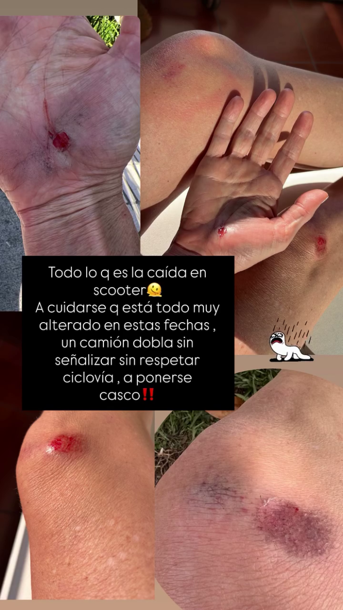 María José Prieto compartió imágenes de su accidente en scooter María José Prieto compartió imágenes de su accidente en scooter