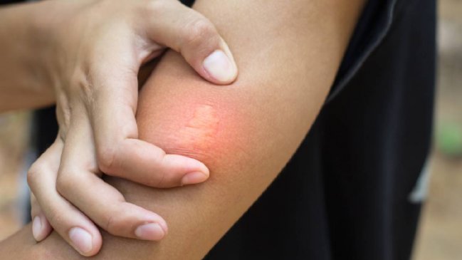 Cómo cuidar y prevenir las picaduras de zancudos y otros insectos