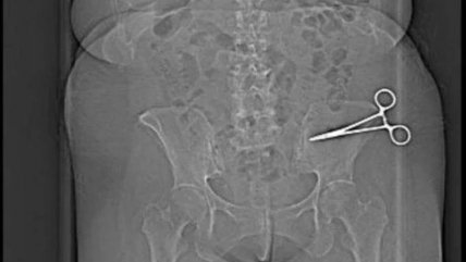   Mujer acusa negligencia médica tras cirugía que dejó tijeras en su abdomen en Italia 