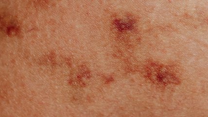   Minsal confirmó caso importado de sarampión en la Región Metropolitana 
