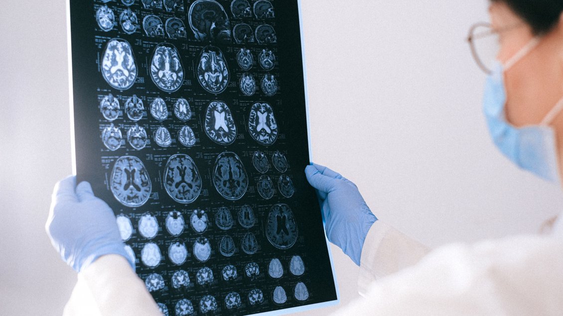 ¿Cómo saber si me está dando un accidente cerebrovascular (ACV)?